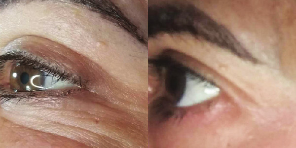 eyes before and after