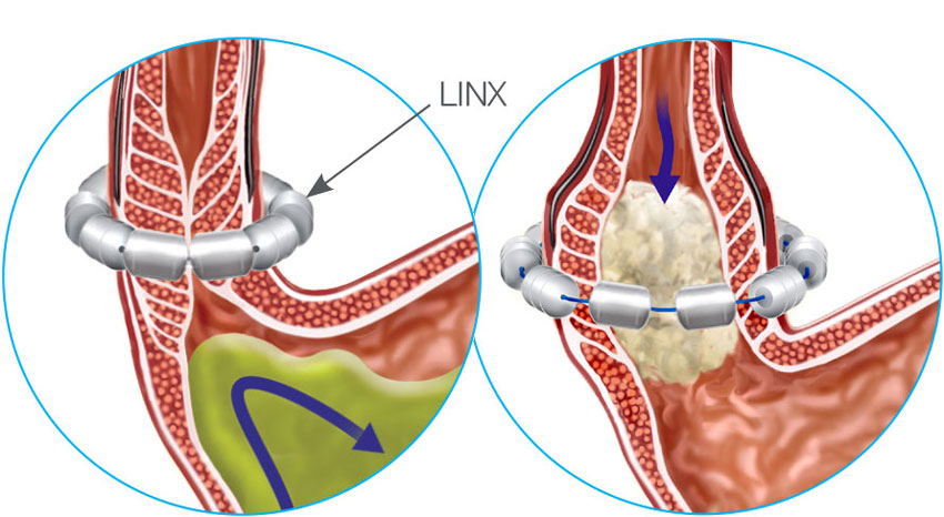 Diagram of LINX