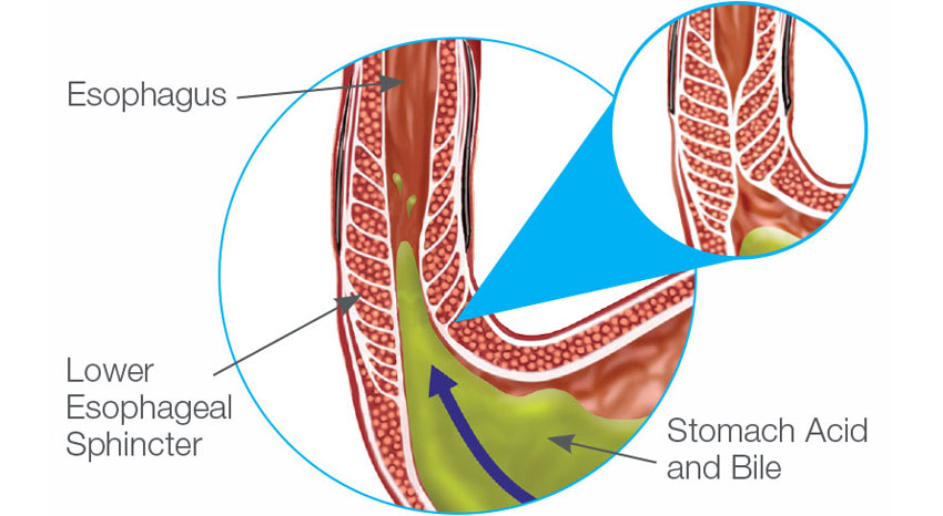 Diagram of Esophagus, Lower Esophageal Spincter, and Stomach Acid and Bile