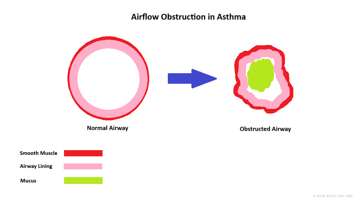Airflow obstruction in asthma