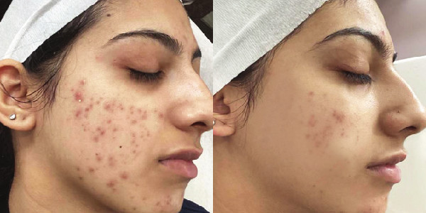 acne before and after